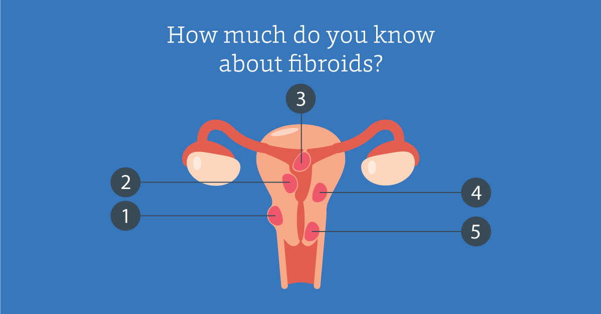 Do You Need To Worry About Fibroids? - Bridge Clinic